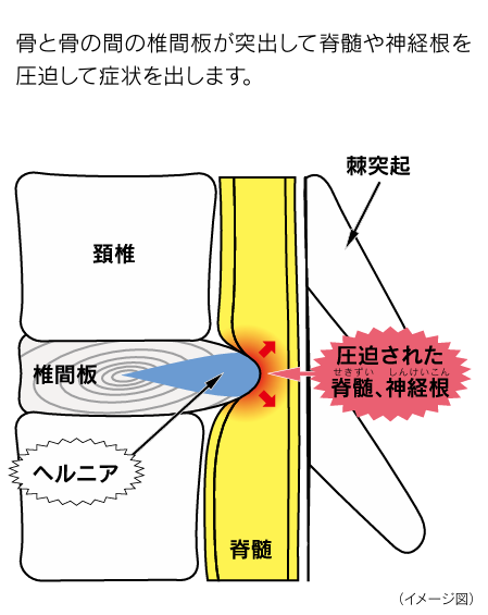 骨と骨の間の椎間板が突出して脊髄や神経根を圧迫して症状を出します