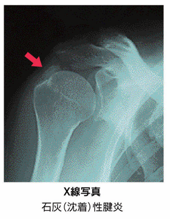 石灰沈着性腱板炎X線写真