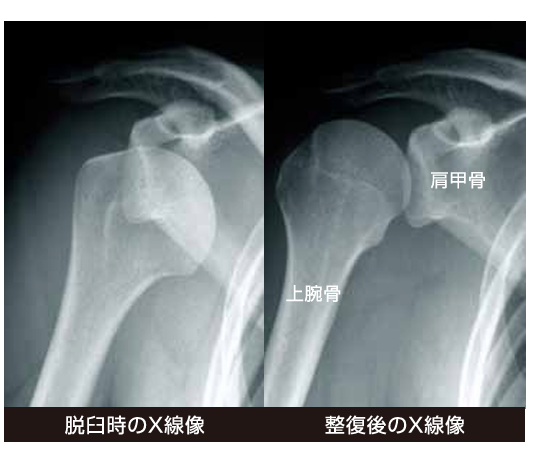 脱臼時と整復後のX線画像