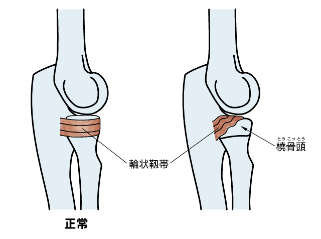 肘の靱帯