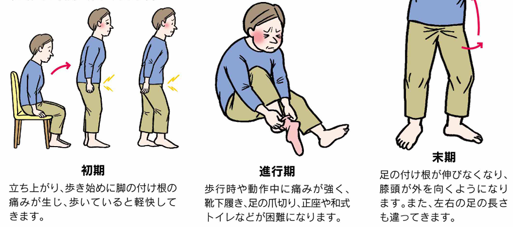 変形性股関節症