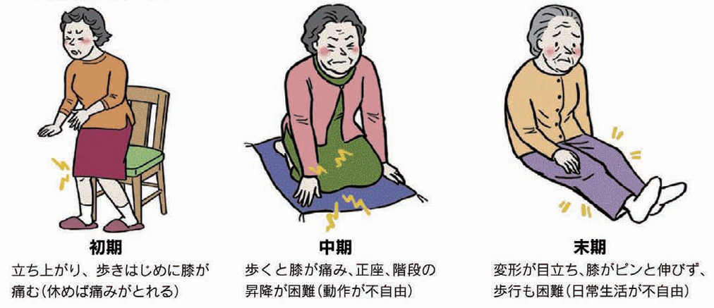 変形性膝関節症