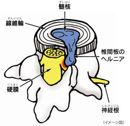 腰椎椎間板ヘルニア