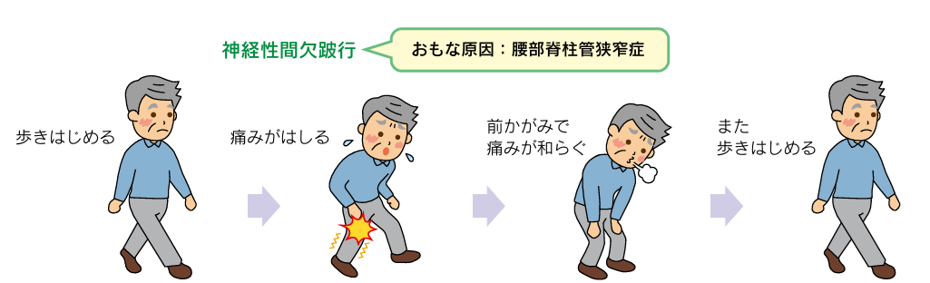 腰部脊柱管狭窄症